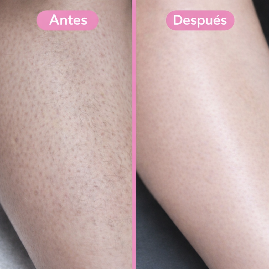 DermaCrystal™ - Depilador Corporal